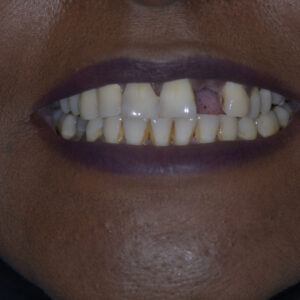 زراعة الأسنان - زراعة الأسنان فى مصر - مركز وندرز لعلاج الاسنان