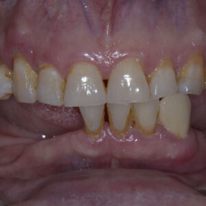 زراعة الأسنان - زراعة الأسنان فى مصر - مركز وندرز لعلاج الاسنان