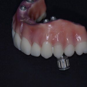 زراعة الأسنان - زراعة الأسنان فى مصر - مركز وندرز لعلاج الاسنان