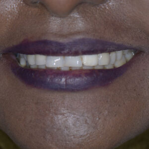 زراعة الأسنان - زراعة الأسنان فى مصر - مركز وندرز لعلاج الاسنان