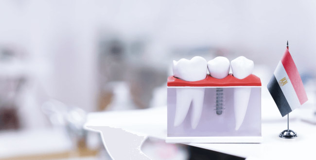 أسعار-زراعة-الأسنان-في-مصر (1) أسعار زراعة الأسنان في مصر - مركز وندرز لعلاج الاسنان - اسعار زراعة الاسنان فى مصر