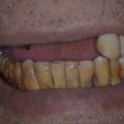 _DSC4817 Lost upper teeth - Jawbone Resorption