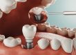 أضرار زراعة الأسنان - Side Effects of Dental Implants