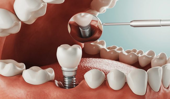 أضرار زراعة الأسنان أضرار زراعة الأسنان - Side Effects of Dental Implants