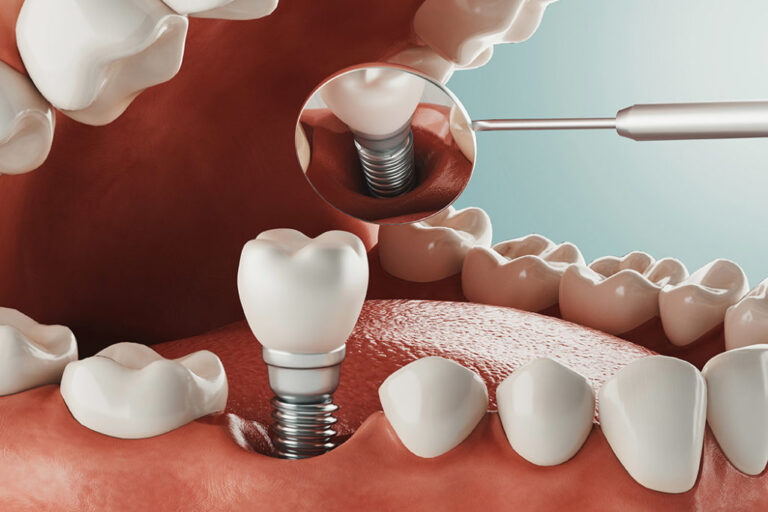 أضرار زراعة الأسنان أضرار زراعة الأسنان - Side Effects of Dental Implants