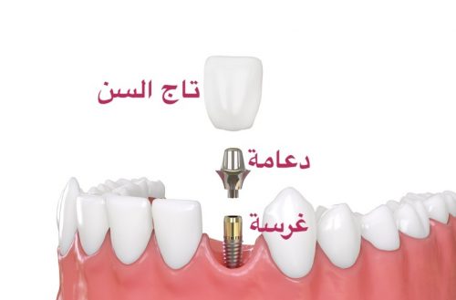 Dental implants - زراعة الأسنان