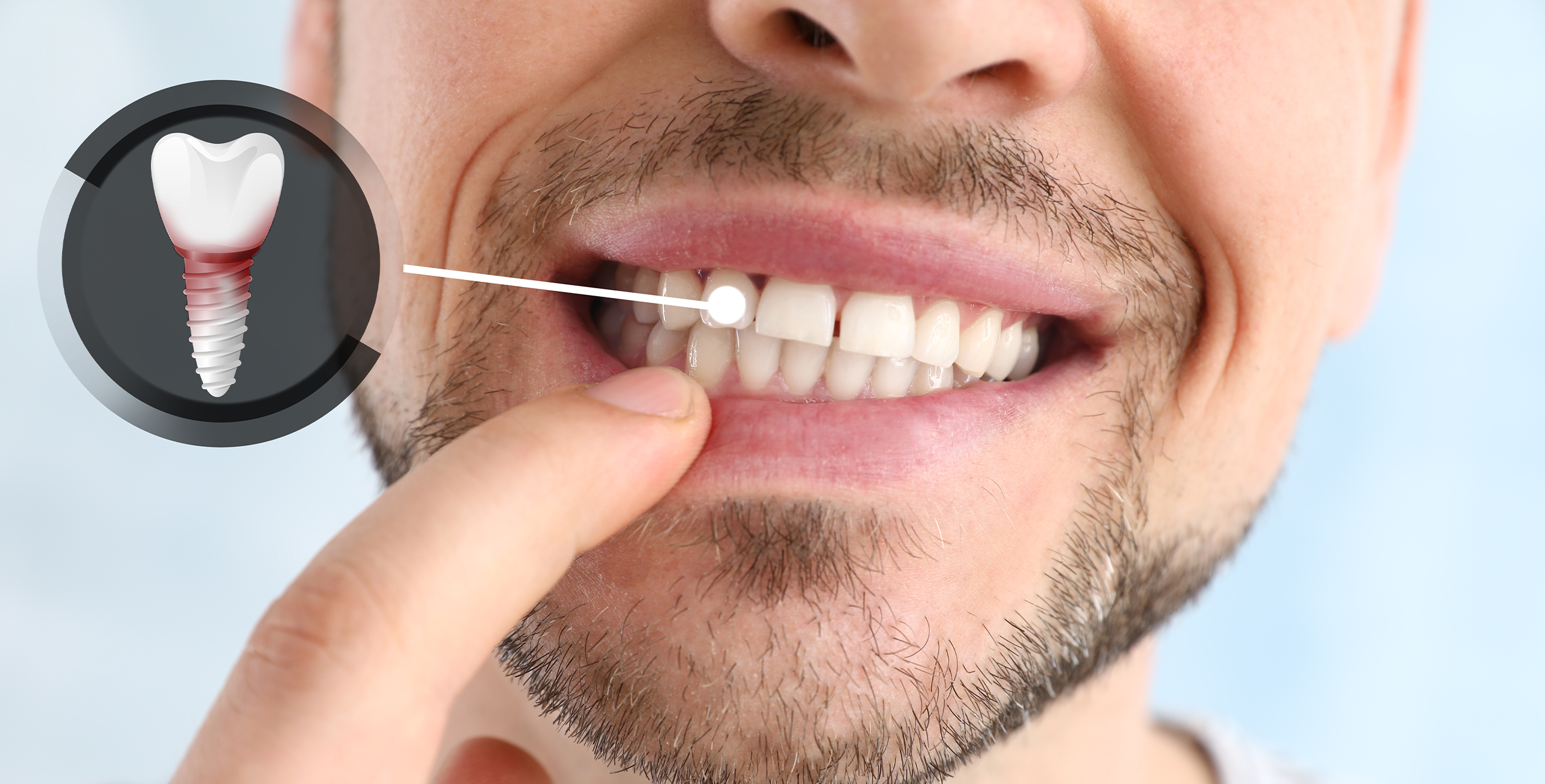 فشل زراعة الاسنان - الأعراض والأسباب وكيفية علاجه - مركز وندرز