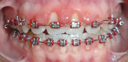اضرار تقويم الأسنان - مقالات المدونة
