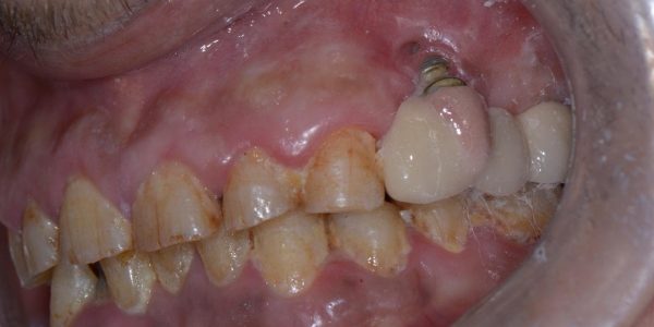 فشل زراعة الاسنان - مقالات المدونة