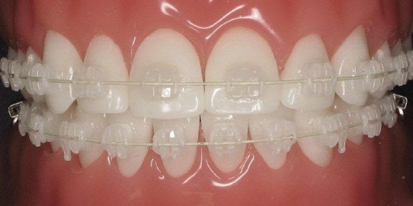 انواع تقويم الأسنان