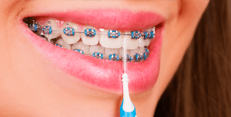 تنظيف تقويم الأسنان - مركز وندرز لعلاج الاسنان - تنظيف تقويم الاسنان