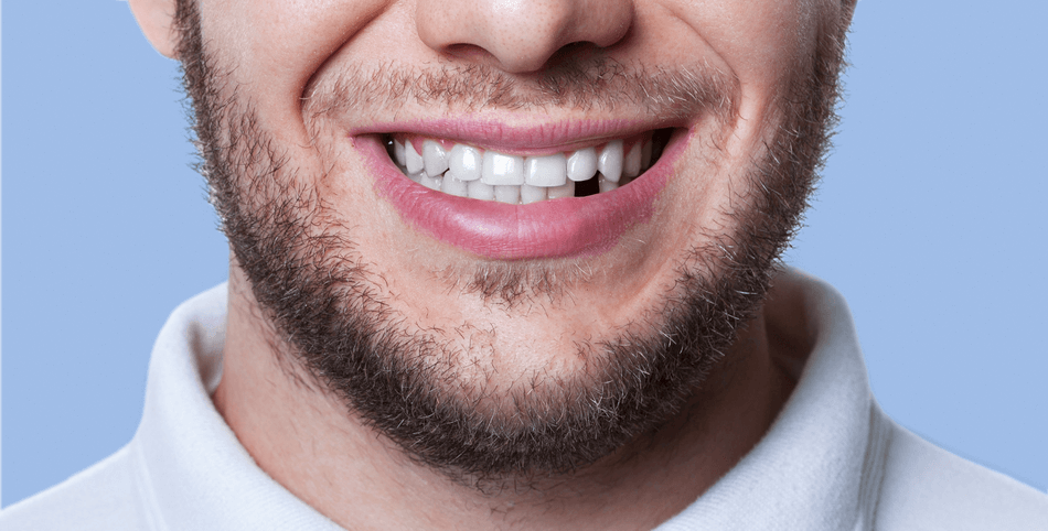 أنواع-عملية-تركيب-الأسنان-الأمامية (1) تركيب الاسنان الامامية - مركز وندرز لعلاج الاسنان - Anterior Teeth Replacement