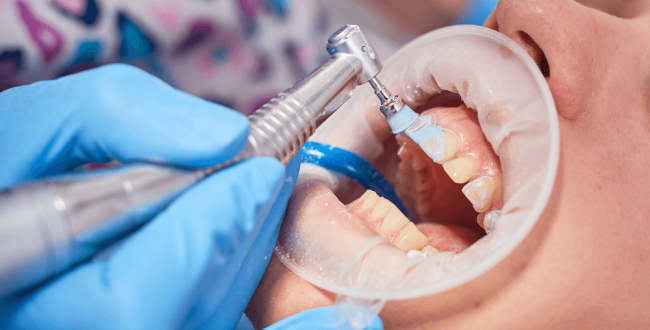 طبقة-جير-الأسنان-واضراره (1) جير الأسنان - مركز وندرز لعلاج الاسنان - جير الاسنان - Dental Calculus