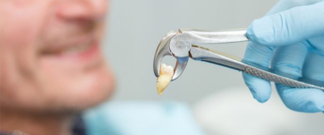 خلع الأسنان خلع الأسنان - مركز وندرز لعلاج الاسنان - خلع الاسنان