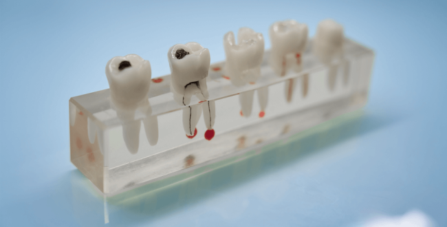 أنواع-حشو-الأسنان (1) حشو الأسنان - مركز وندرز لعلاج الاسنان - حشو الاسنان - dental filling