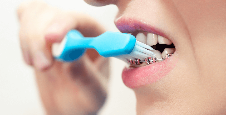 فرشاة-أسنان-التقويم (1) فرشاة أسنان التقويم - مركز وندرز لعلاج الاسنان - فرشاة اسنان للتقويم- فرشاة تقويم الاسنان