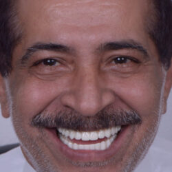 DSC5719 (1) تآكل عظام الفك - Lost upper teeth - تآكل عظام الفكين - مركز وندرز لعلاج الاسنان