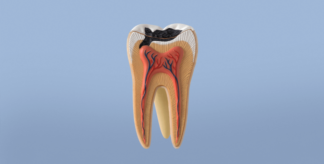 تسوس-الأسنان-وكيف-يحدث (1) تسوس الأسنان - مركز وندرز لعلاج الاسنان - تسوس الاسنان
