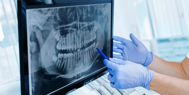 تثوير-الأشعة (1) الأشعة السينية - مركز وندرز لعلاج الاسنان - الاشعة السينية