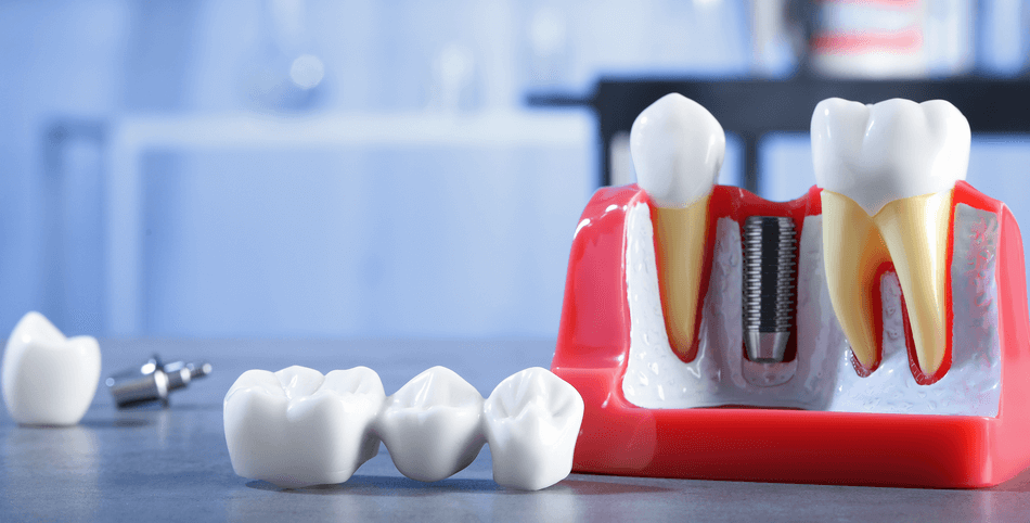 زراعة-الزيجوما (1) زراعة الزيجوما - مركز وندرز لعلاج الاسنان - Zygoma Implants