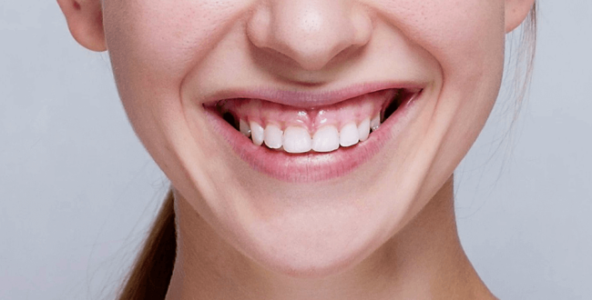 الابتسامة-اللثوية (1) الإبتسامة اللثوية - مركز وندرز لعلاج الاسنان - الابتسامة اللثوية