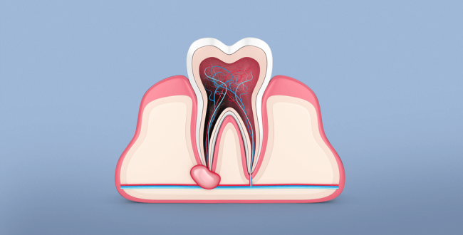 خراج-الأسنان (1) خراج الأسنان - مركز وندرز لعلاج الاسنان - خراج الاسنان