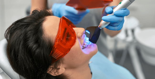 لومنيرز-الأسنان (1) لومينير الأسنان - مركز وندرز لعلاج الاسنان - Lumineers