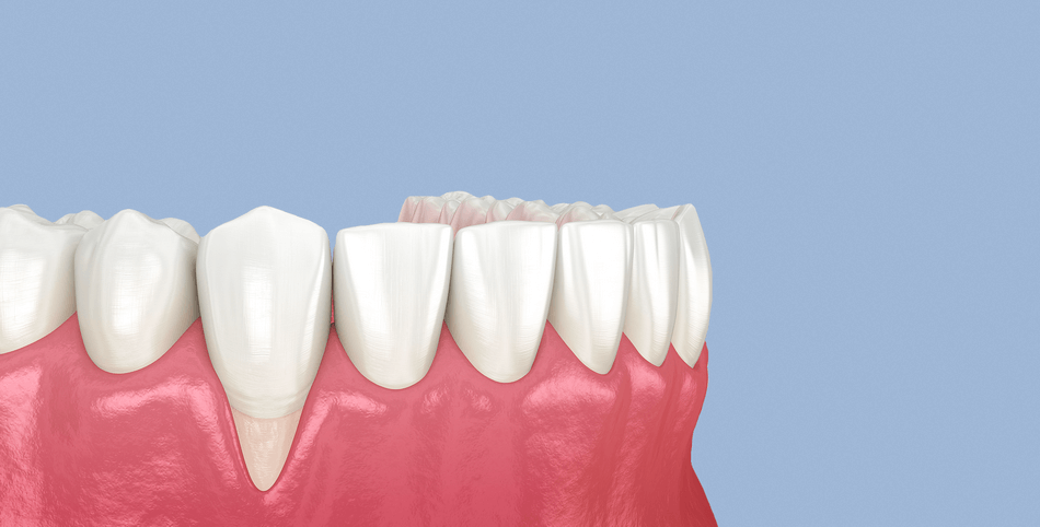 انحسار-اللثة (1) انحسار اللثة - مركز وندرز لعلاج الاسنان