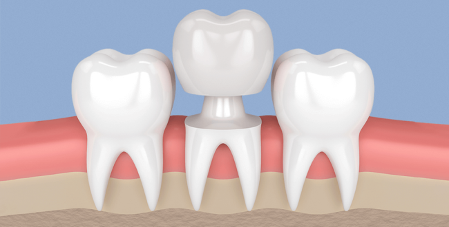 تيجان-الأسنان-الصناعية (1) طربوش الأسنان - مركز وندرز لعلاج الاسنان - طربوش الاسنان
