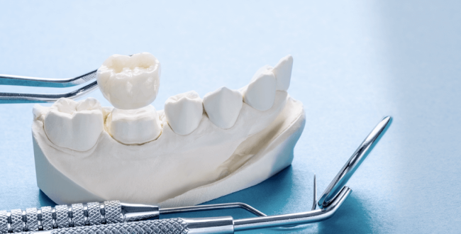 ترميم-لأسنان (1) ترميم الأسنان - مركز وندرز لعلاج الاسنان - ترميم الاسنان