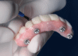 تركيبات الكل علي أربعة - مركز وندرز لعلاج الاسنان - All-on-4 dental implants