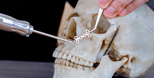 زراعات-الثريا (1) زراعات الثريا - مركز وندرز لعلاج الاسنان - Thariya Implant