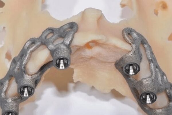 زراعة أسنان الثريا زراعات الثريا - مركز وندرز لعلاج الاسنان - زراعة الثريا