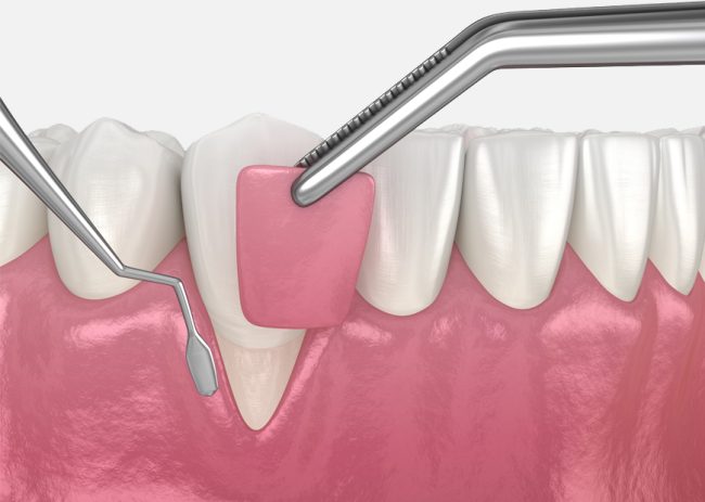 GumGrafting_rec-1 زراعة اللثة جراحياً - مركز وندرز لعلاج الاسنان - زراعة اللثة