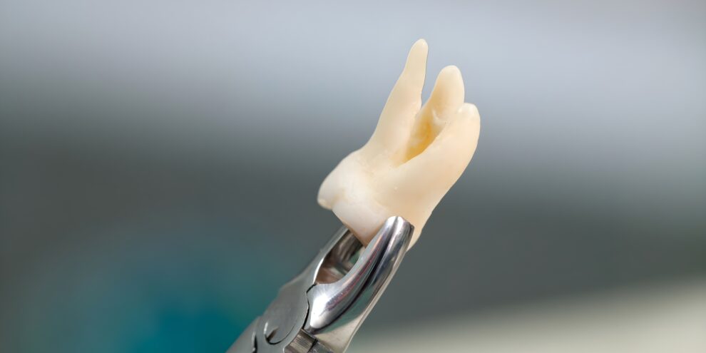 إجراء خلع الأسنان - Tooth Extraction Procedure