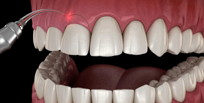 gumbg مركز وندرز لعلاج الاسنان - نحت اللثة