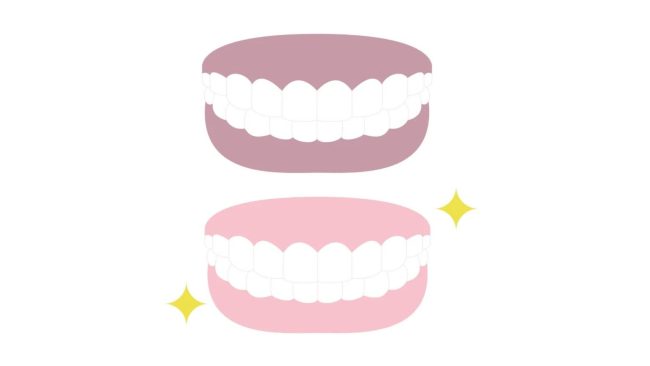 Untitled design إزالة تصبغات اللثة بالليزر - مركز وندرز لعلاج الاسنان