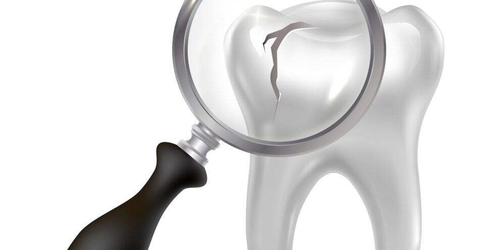 ربط الأسنان - Dental bonding