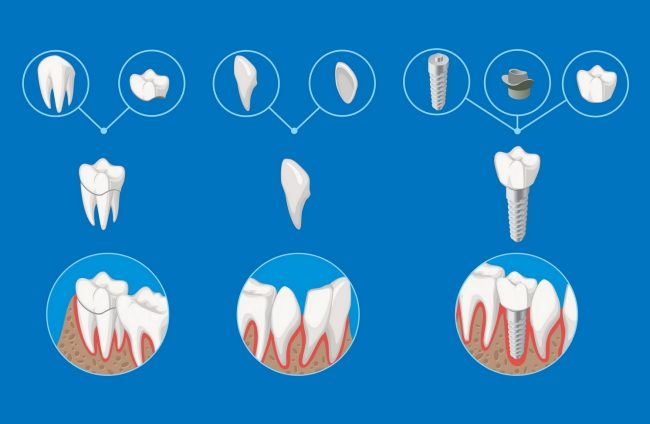 teeth construction إعادة بناء الفم بالكامل - مركز وندرز لعلاج الاسنان