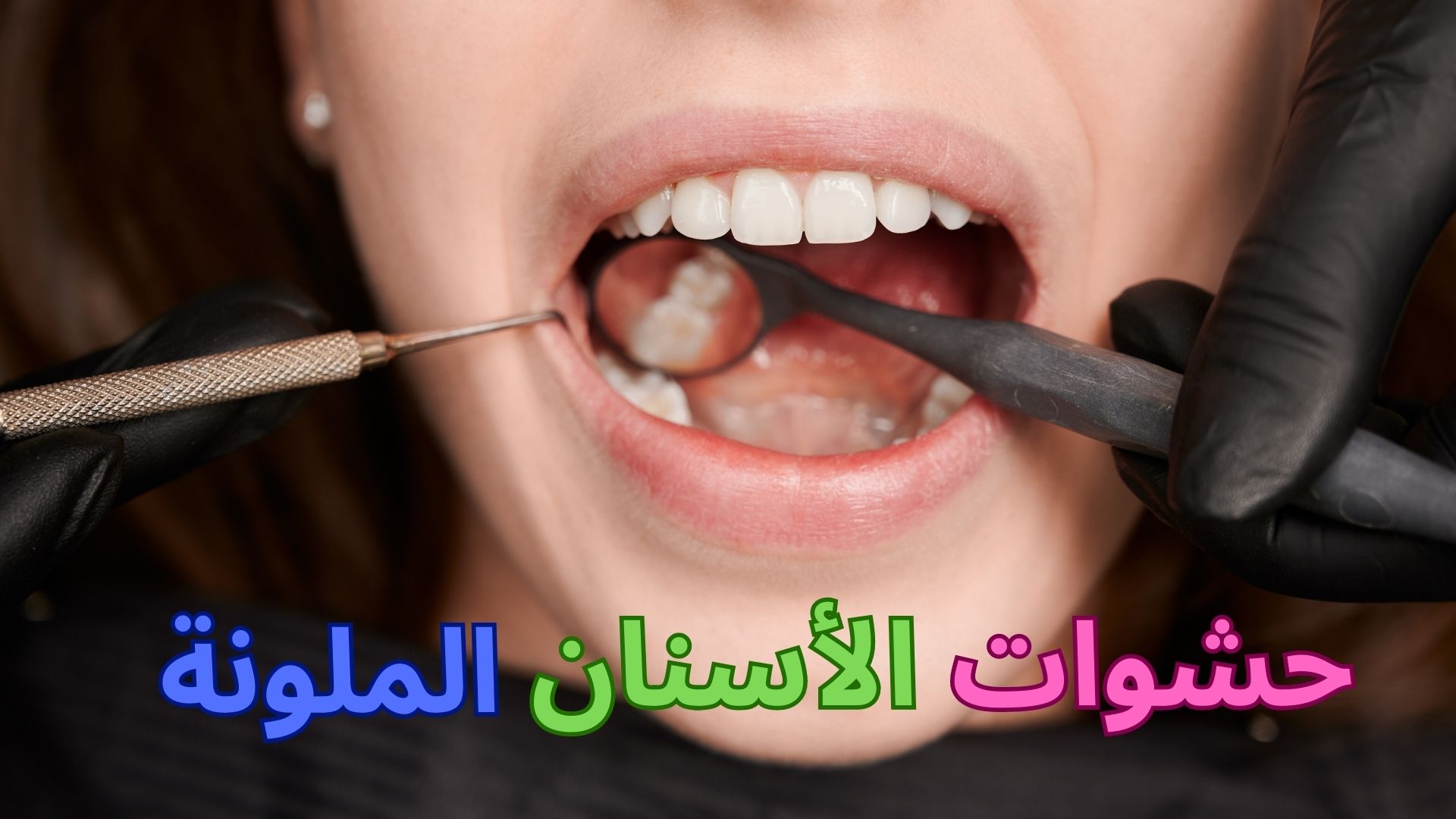 حشوات الأسنان الملونة - مركز وندرز لعلاج الاسنان - Colored Dental Fillings