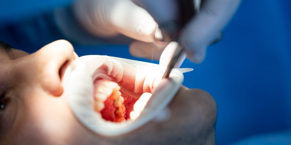 طعم اللثة - gum grafting