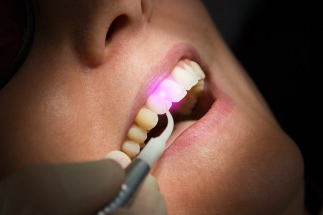 Laser root canal treatment علاج قناة الجذر بالليزر - مركز وندرز لعلاج الاسنان