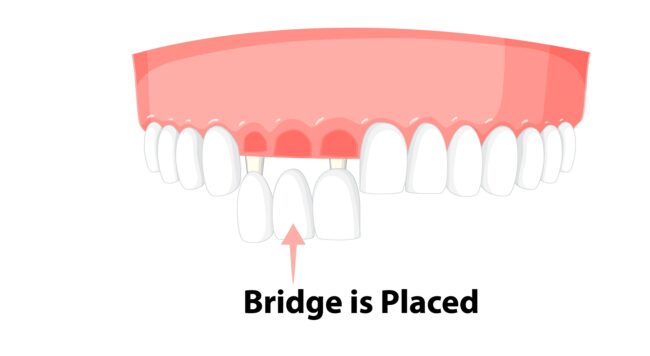 جسور الأسنان المؤقتة - Temporary dental bridges