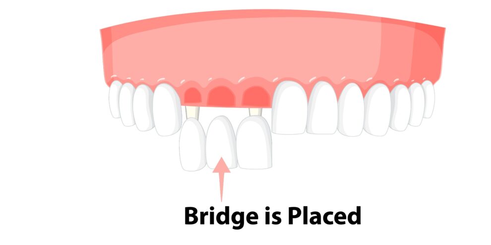 جسور الأسنان المؤقتة - Temporary dental bridges