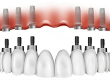 تركيبات الأسنان All on 6 - All on 6 Dental Implants