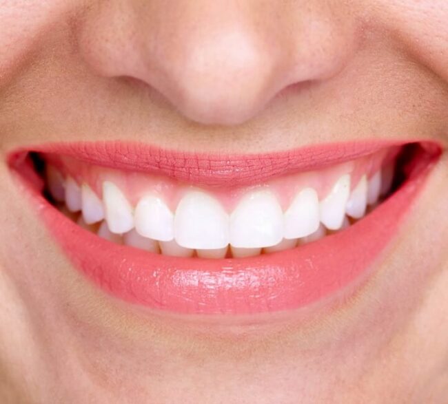 closeup-of-smile-with-white-healthy-teeth تبييض الأسنان من الداخل