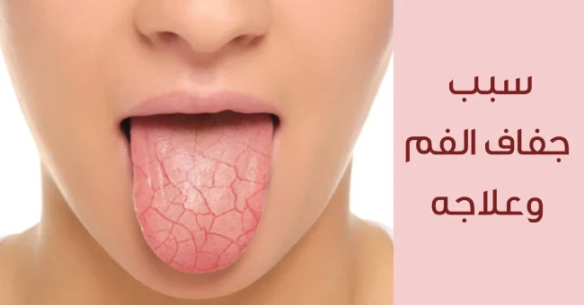 جفاف-الفم اعراض جفاف الفم - مركز وندرز لعلاج الاسنان