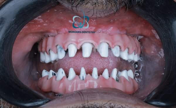 زراعة الزيجوما في الوجنة - مركز وندرز لعلاج الاسنان