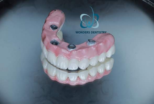 زراعة الزيجوما في الوجنة - مركز وندرز لعلاج الاسنان