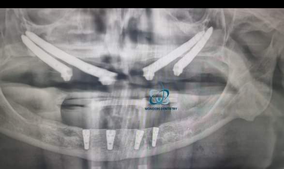 زراعة الزيجوما في الوجنة - مركز وندرز لعلاج الاسنان